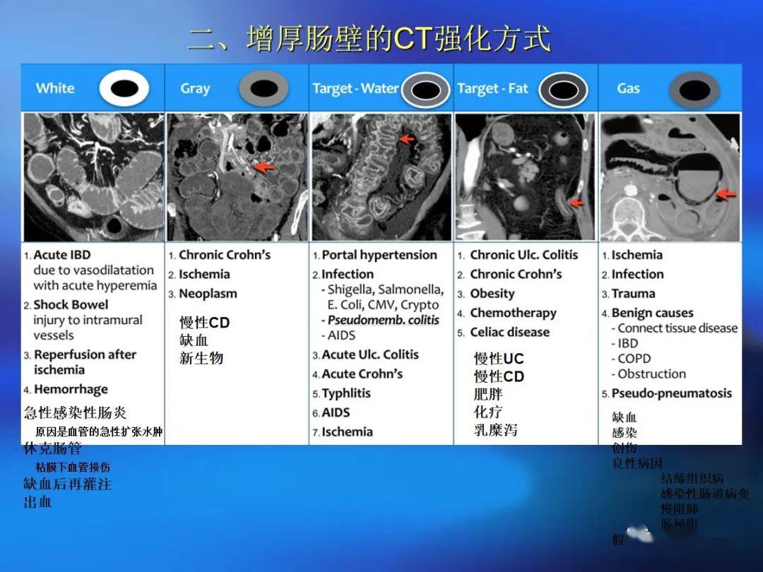 肠道壁增厚ct表现