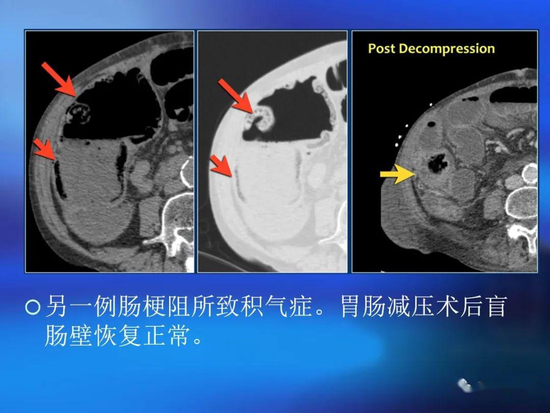 肠道壁增厚ct表现