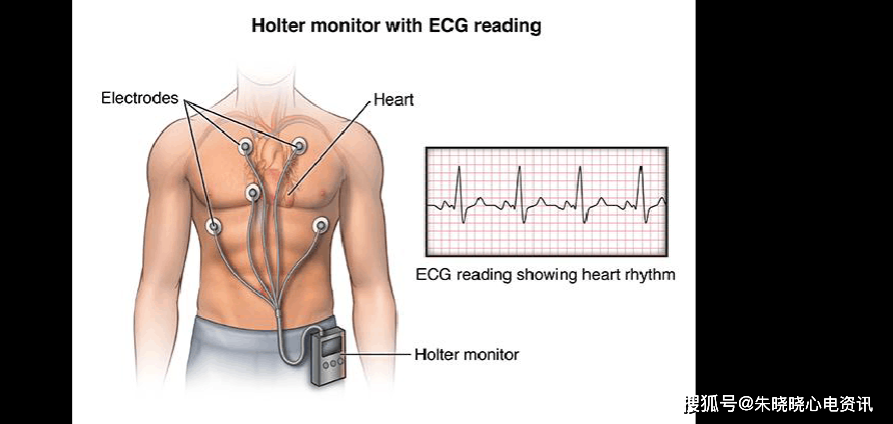 心电图检查 | 你知道几种?