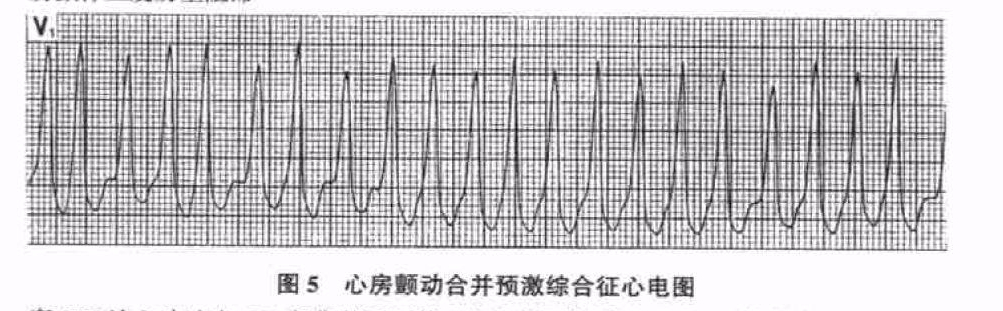 房颤时如果心室率极快(一般超过180bpm) 且qrs 波宽大畸形,必须考虑