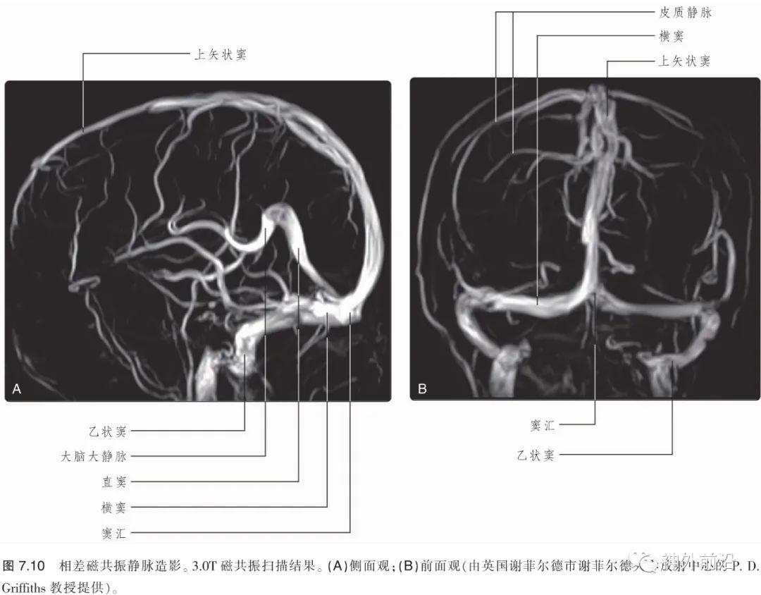 解剖 脊髓和脑的静脉回流—中枢神经系统的血管