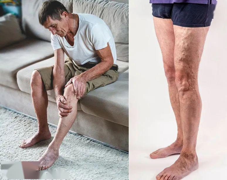 蚯蚓腿竟是血栓前兆德国变态腿部按摩刮一刮消凸止痛十年不复发