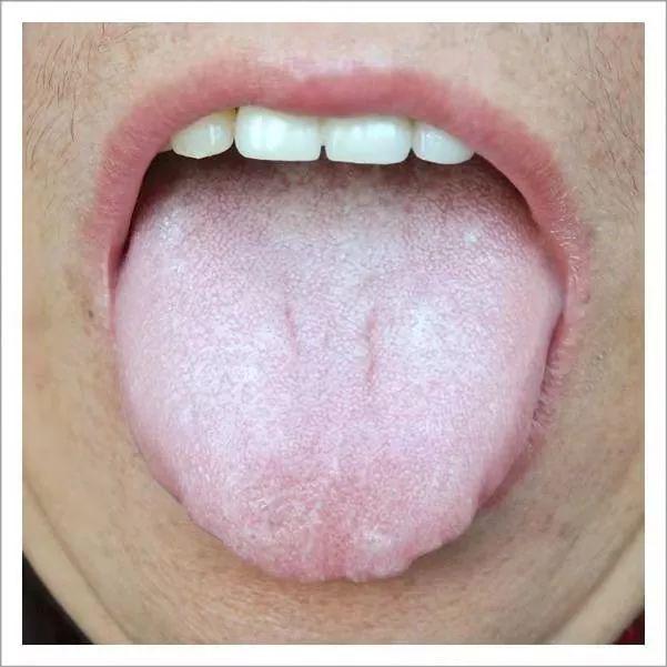 这张舌像与上边健康,干净的舌头相比,会显得淡白许多.