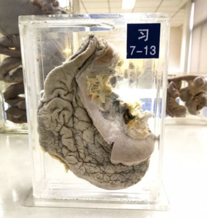 肺癌是如何早发现?当频繁有这4个症状时,应该及时就医