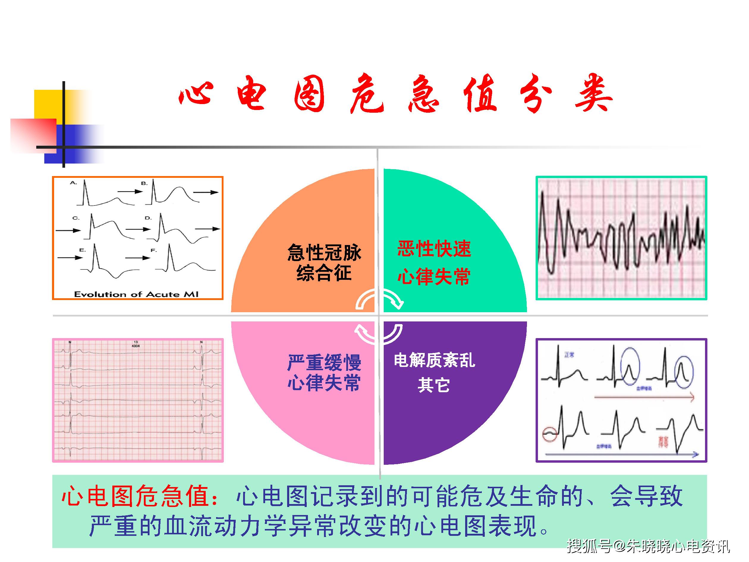 心电图危急值专家共识解读