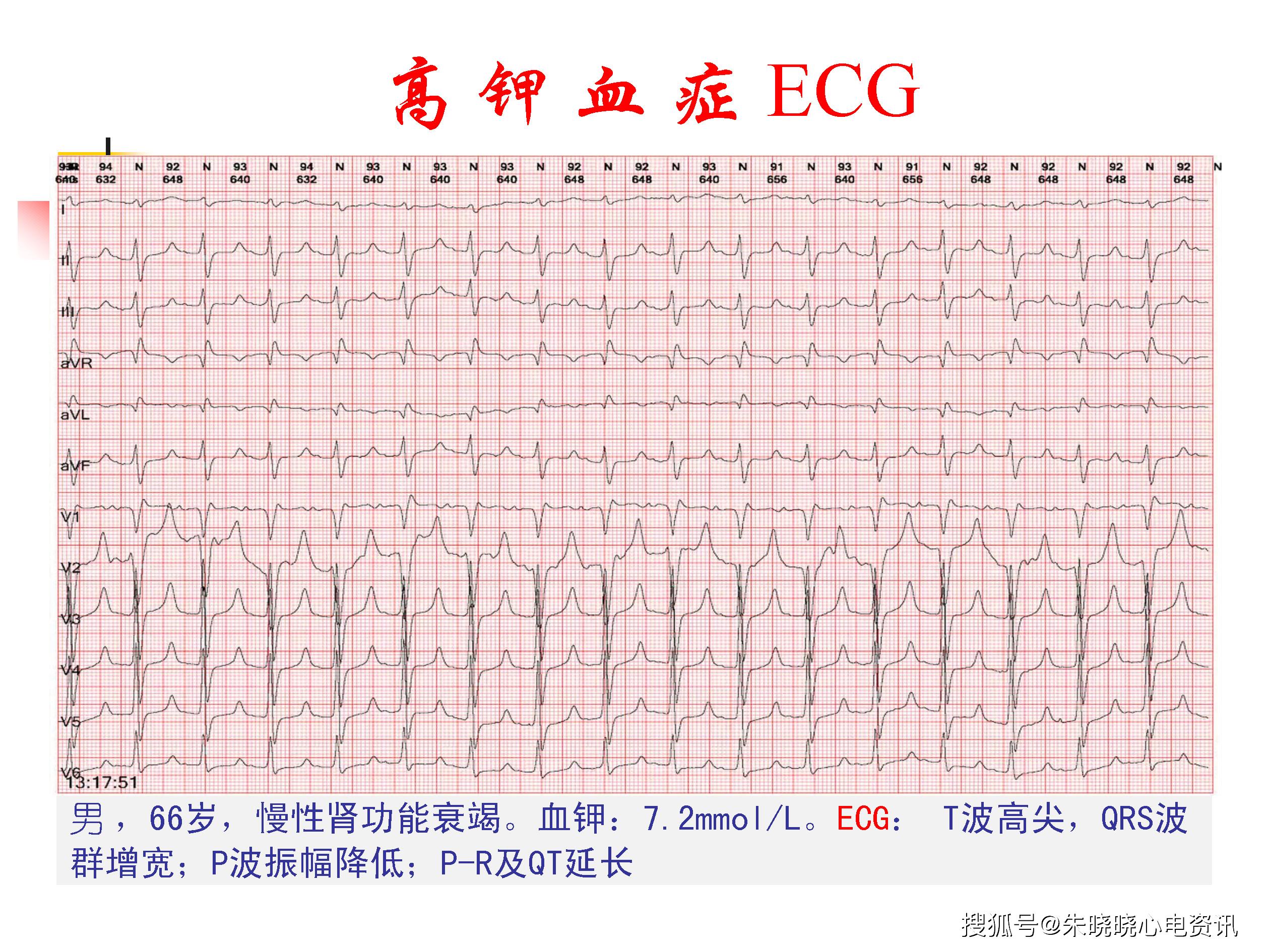 心电图危急值专家共识解读