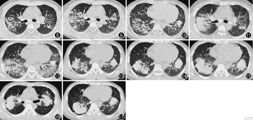 【临床病例(理)讨论】矽肺伴急性纤维素性机化性肺炎