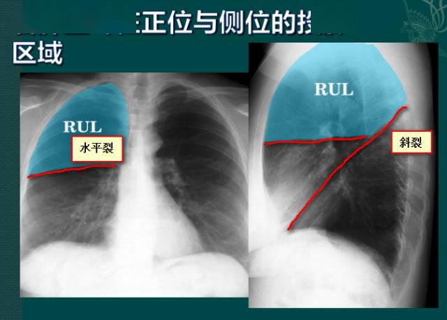 读完此文,终于学会看胸片了