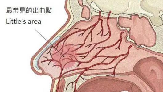 小孩鼻炎流鼻血怎么办