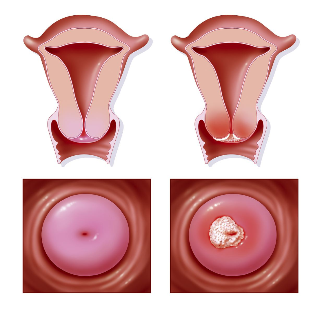 宫颈癌的三个早期信号