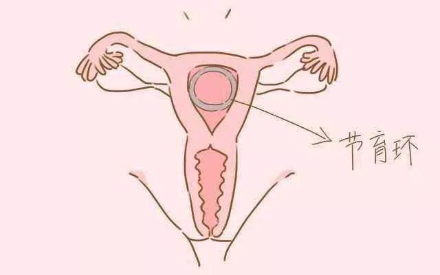 宫腔内放置的节育环可使子宫内膜出现无菌性炎症反应,白细胞和巨噬