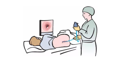 肠镜检查:可准确观察到肠道粘膜的微小变化,并对小的息肉,腺瘤采取镜