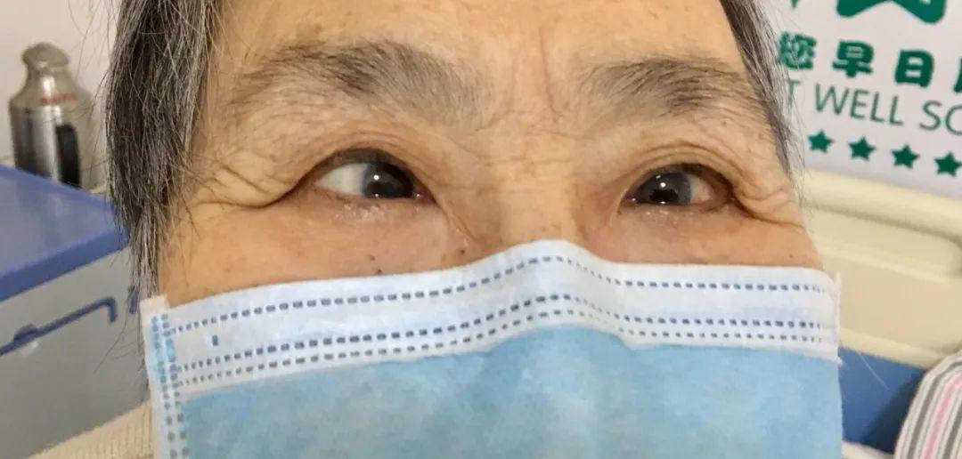 【眼科医生门诊手记】75岁高龄老人实施斜视手术——追求完美的刘大姐
