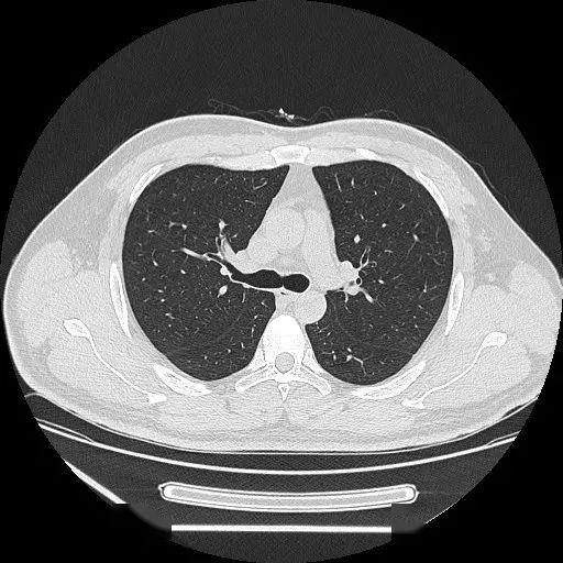 做一次ct,对身体的伤害有多大?