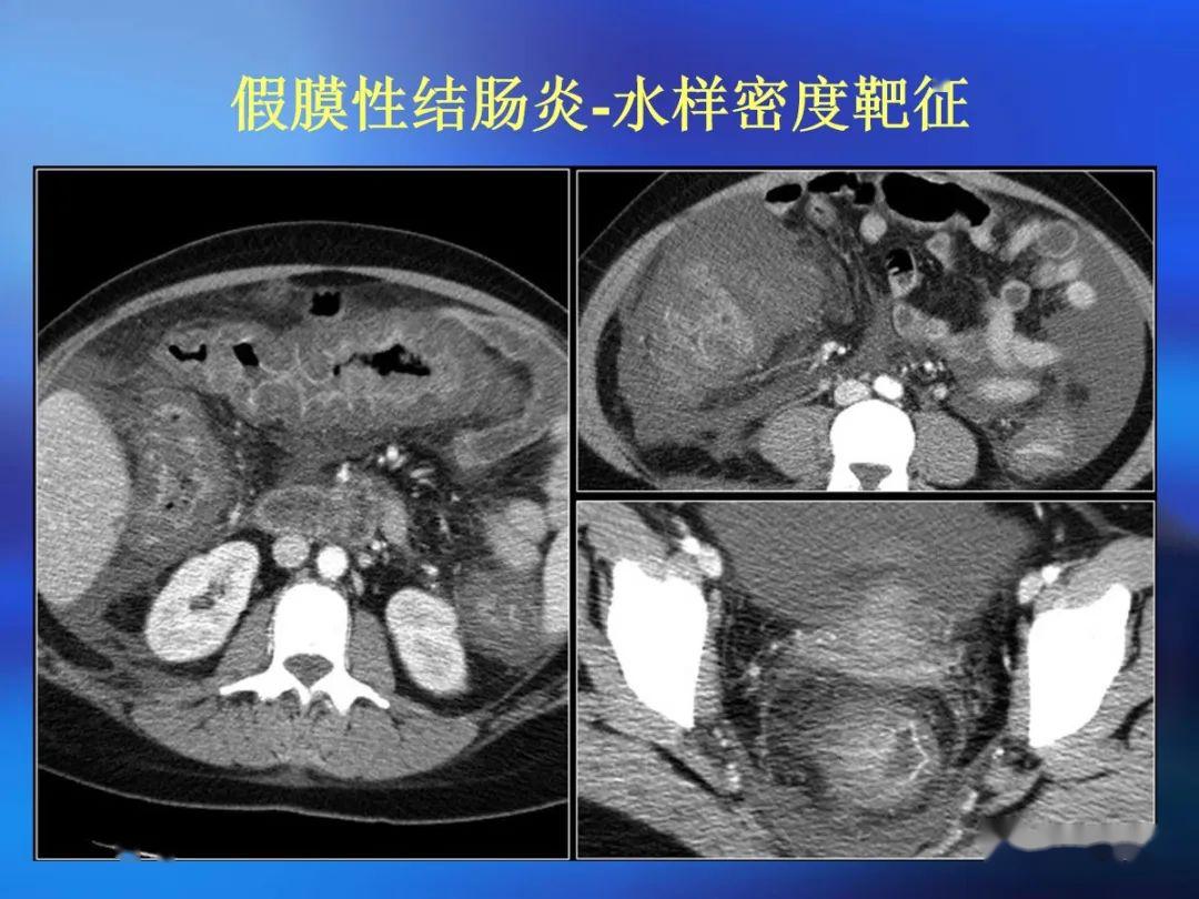 肠道壁增厚ct表现