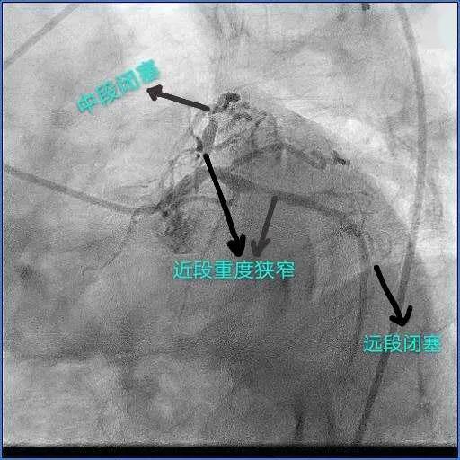 术后显示冠状动脉三支主要血管均严重狭窄(左主干末端狭窄,前降支自中