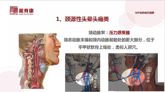 病例:根治颈源性眩晕,除了对上段颈椎复位,还需要做什么?