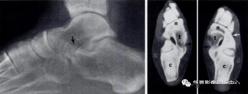 影像拾遗跗骨联合的影像诊断