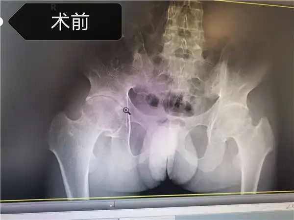 一位得了强直性脊柱炎的人手术前B超图