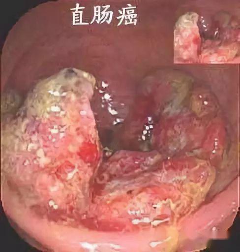 直肠癌一般无疼痛,但癌肿浸润肛管和括约肌则疼痛显著,恶性肿瘤细胞