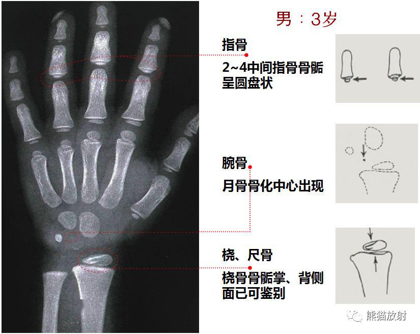 收藏丨骨龄图谱方便随时对照