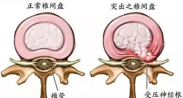 腰椎间盘突出和正常对比图