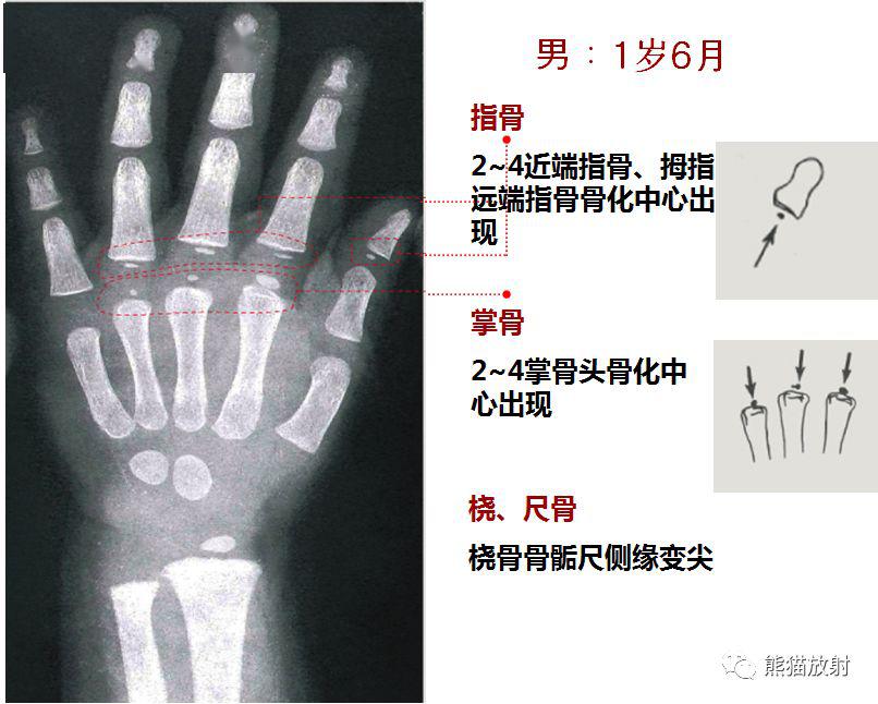 收藏丨骨龄图谱!(方便随时对照)_年龄