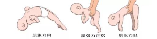#体检#孩子体检“肌张力高”？这是什么？我被吓到了！