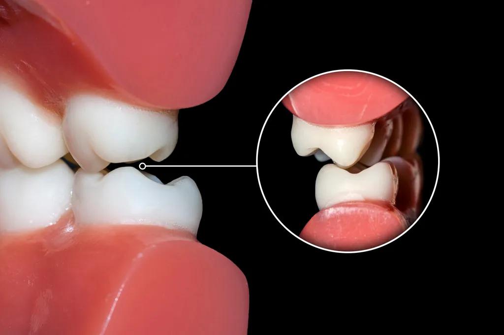 如果只矫正单排牙齿,容易让上下颌牙齿的咬合产生无法对位的问题
