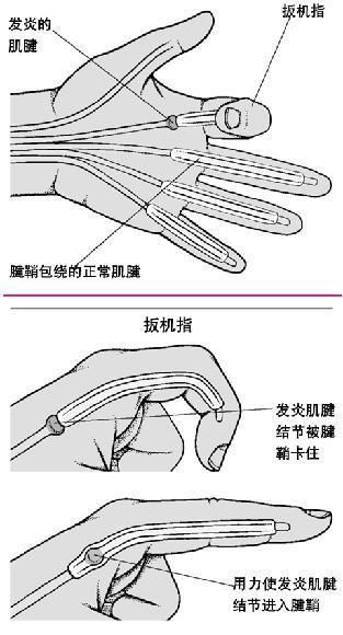 小儿先天性拇指狭窄性腱鞘炎主要表现为患儿拇指指间关节屈曲,主动