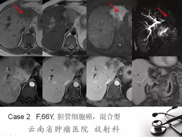 胆管细胞癌的ct及mri诊断