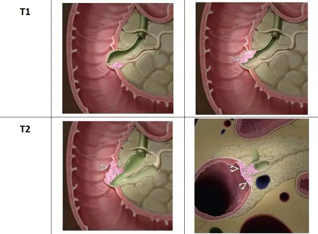 壶腹癌t分期示意图 责任编辑