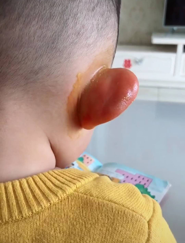 「蚊虫」蚊子“吻了”儿子两只耳朵，结果一觉醒来，哈哈哈趁老母亲不备