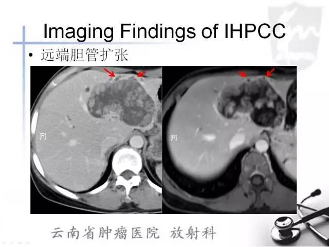 胆管细胞癌的ct及mri诊断