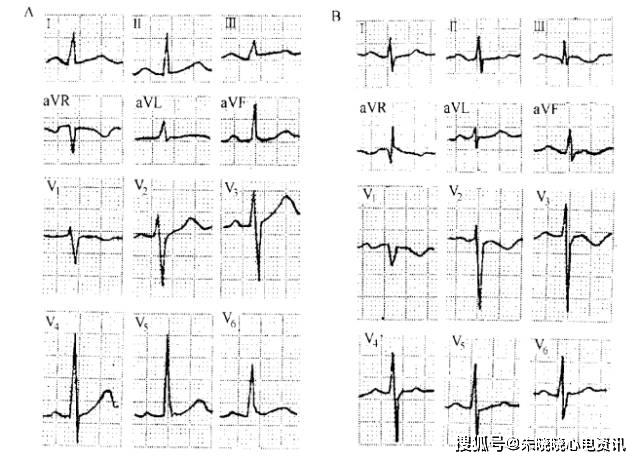 心电图表现:①v3～v6,t波对称性倒置,呈冠状t波;②v3～v6导联st段下降