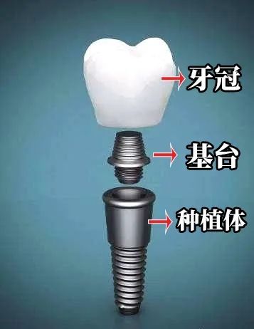 小小的种植牙冠是什么材料?2.