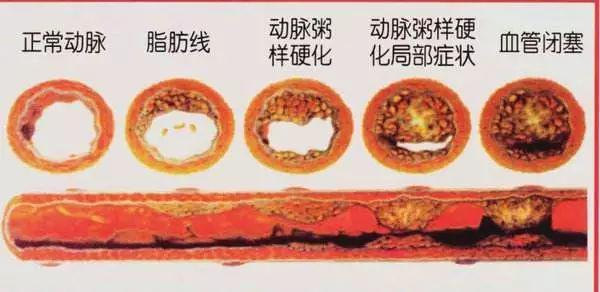 那么,为啥有人会发生动脉粥样硬化斑块呢?