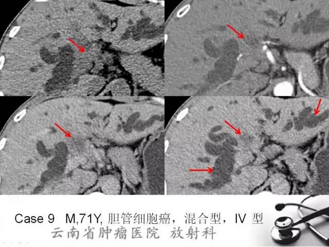 胆管细胞癌的ct及mri诊断