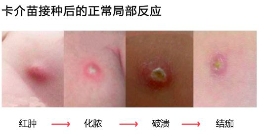 胳膊■宝宝胳膊上没疤，还要再打一针吗？卡介苗打完