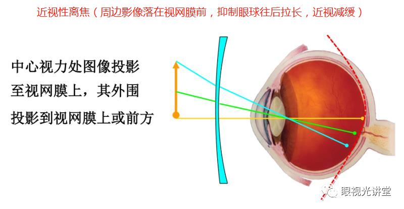 【最全】离焦,环焦,全焦镜片,你都了解吗?