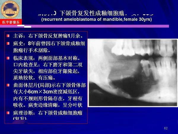 口腔颌面部囊肿肿瘤和肿瘤样病变