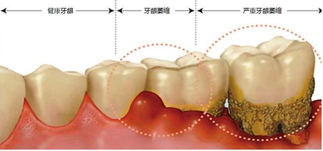 看到牙根外露得越来严重,都快退化到牙根?