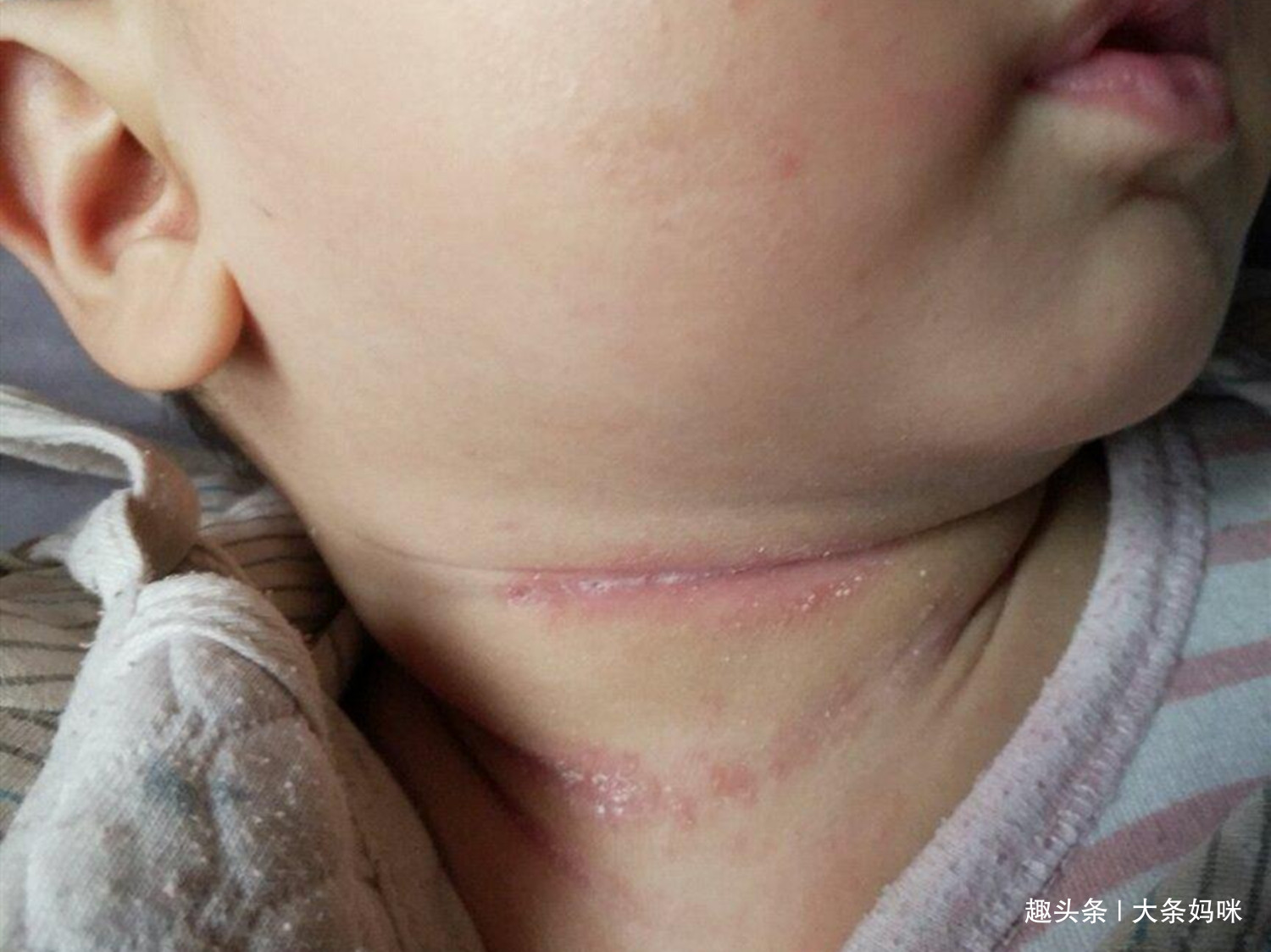 【宝宝】原来是因为它，很多家长都没注意3个月婴儿脖子被“淹”