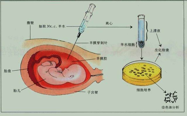 唐氏筛查的原理_每20分钟就有一个唐氏儿出生 孕妈妈产前筛查必不可少(3)