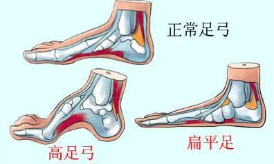 这四双鞋最伤脚,孩子千万不能穿,尤其是第二种!