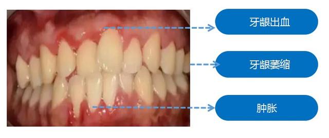 牙龈萎缩牙根暴露牙齿松动