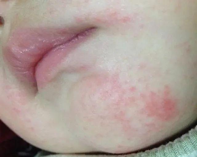 护理■支招 | 宝宝口水疹反复不见好?这些护理细节要注意!