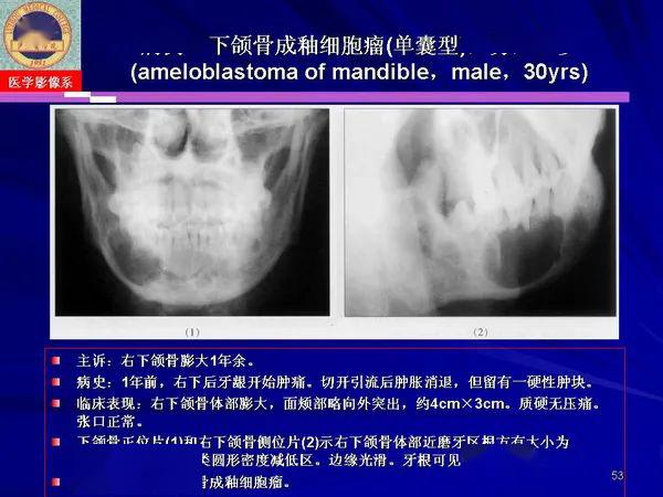 口腔颌面部囊肿肿瘤和肿瘤样病变