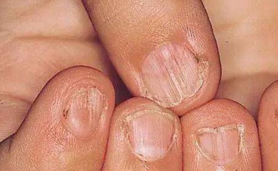 怎么才可以让自己不咬指甲 7416485750ad4a17b31f374c11bf6ffc.jpeg