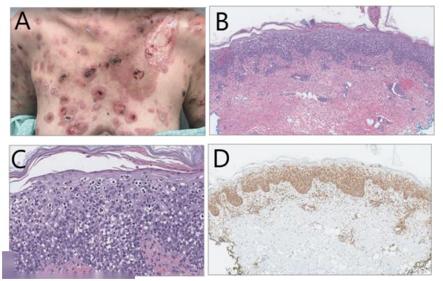 淋巴瘤样丘疹病,d 型可表现为丘疹结节,但